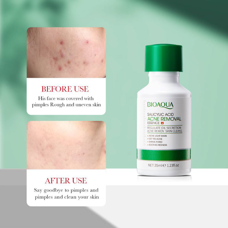 bioaqua-salicylic-acid-acne-removal-essence-6